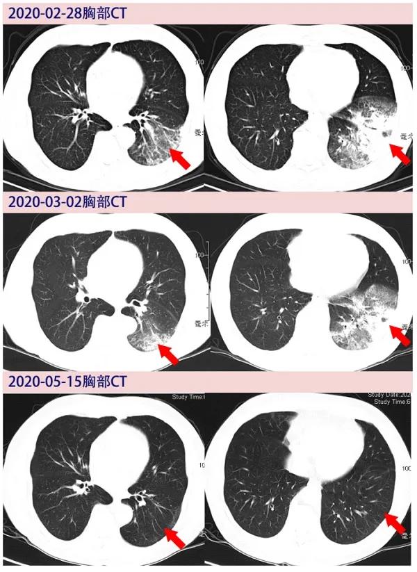 北京新冠肺炎最新动态及防控措施概述